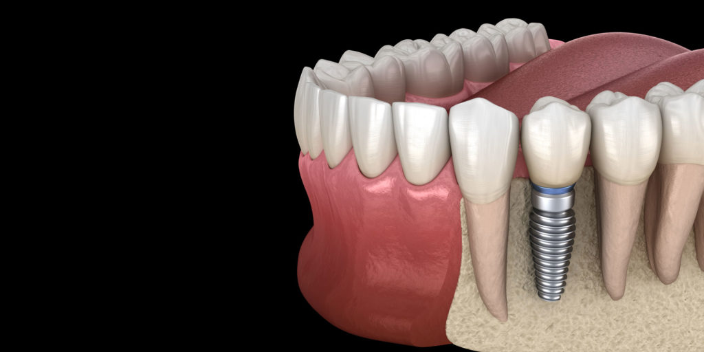 dental implant model