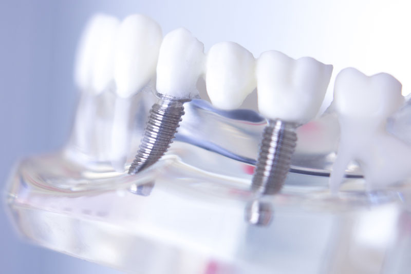 dental implants model