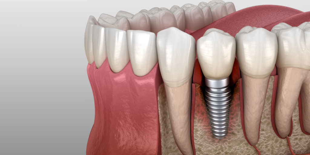 failing dental implant graphic