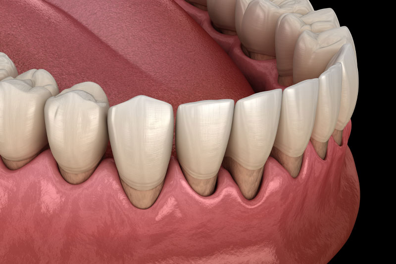 gum recession graphic