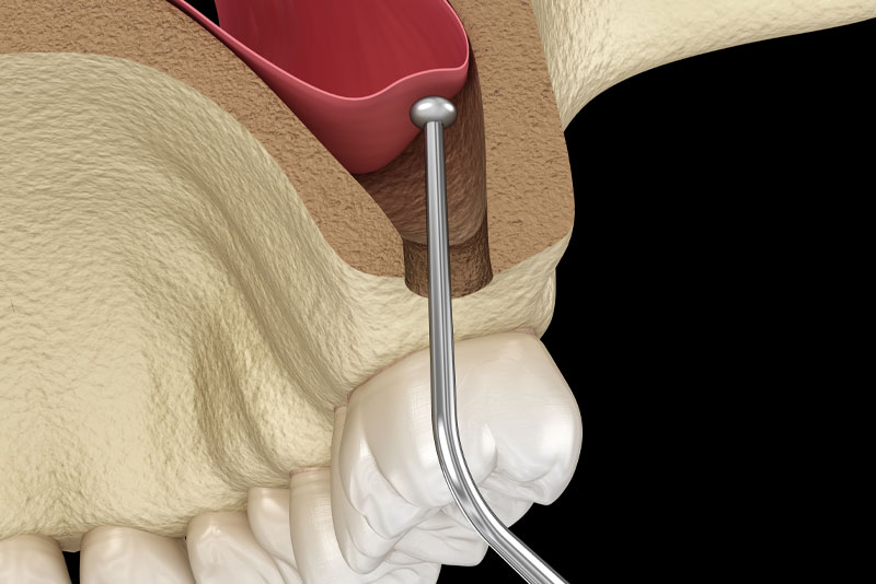 sinus lift graphic